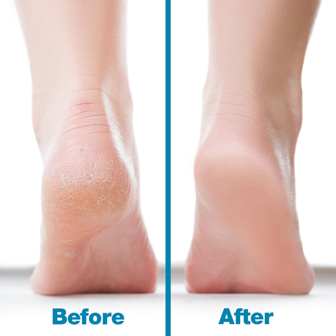 Bite Instruments Foot File Callus Remover - Hard Skin Scrubber for Pedicure
