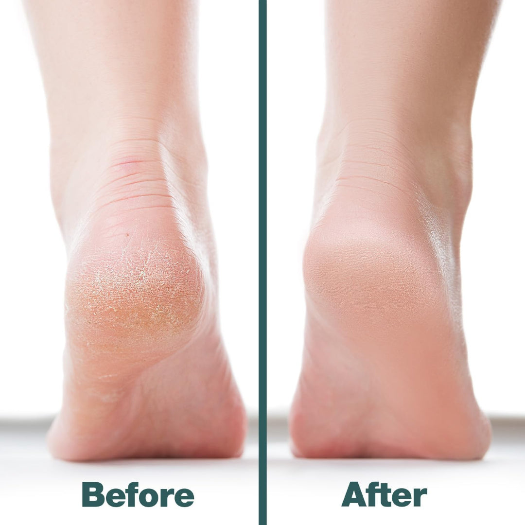 Professional Foot File Callus Remover - Hard Skin Scrubber for Pedicure